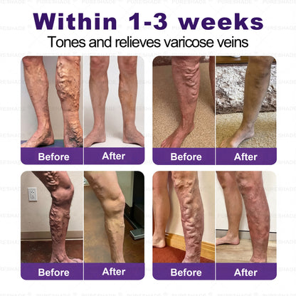 𝐏𝐔𝐑𝐄𝐒𝐇𝐀𝐃𝐄® 𝐕𝐞𝐢𝐧 𝐓𝐚𝐫𝐠𝐞𝐭 𝐌𝐢𝐜𝐫𝐨𝐧𝐞𝐞𝐝𝐥𝐞 𝐏𝐚𝐭𝐜𝐡⚡Instant Relief, Long-Term Results big sale