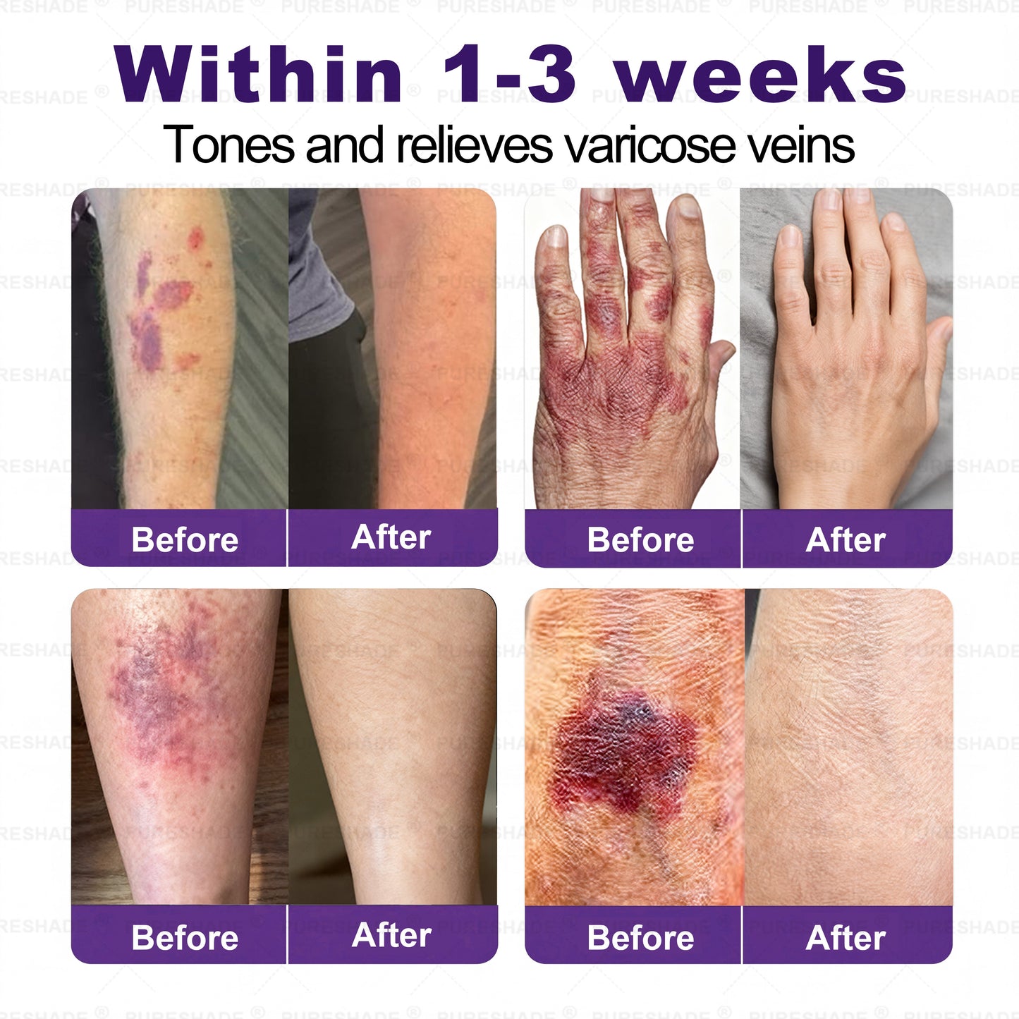 𝐏𝐔𝐑𝐄𝐒𝐇𝐀𝐃𝐄® 𝐕𝐞𝐢𝐧 𝐓𝐚𝐫𝐠𝐞𝐭 𝐌𝐢𝐜𝐫𝐨𝐧𝐞𝐞𝐝𝐥𝐞 𝐏𝐚𝐭𝐜𝐡⚡Instant Relief, Long-Term Results big sale