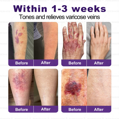 𝐏𝐔𝐑𝐄𝐒𝐇𝐀𝐃𝐄® 𝐕𝐞𝐢𝐧 𝐓𝐚𝐫𝐠𝐞𝐭 𝐌𝐢𝐜𝐫𝐨𝐧𝐞𝐞𝐝𝐥𝐞 𝐏𝐚𝐭𝐜𝐡⚡Instant Relief, Long-Term Results big sale